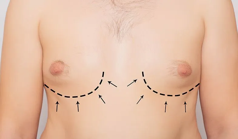 TB Cirugia Estetica 0003 ginecomastia 300x176 1