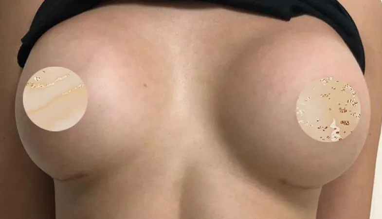 Aumento mamas imagen despues