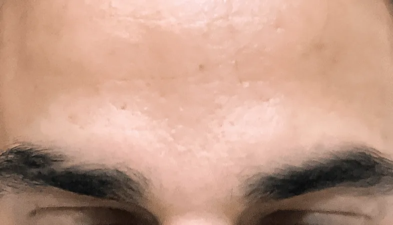 Before and After botox 1