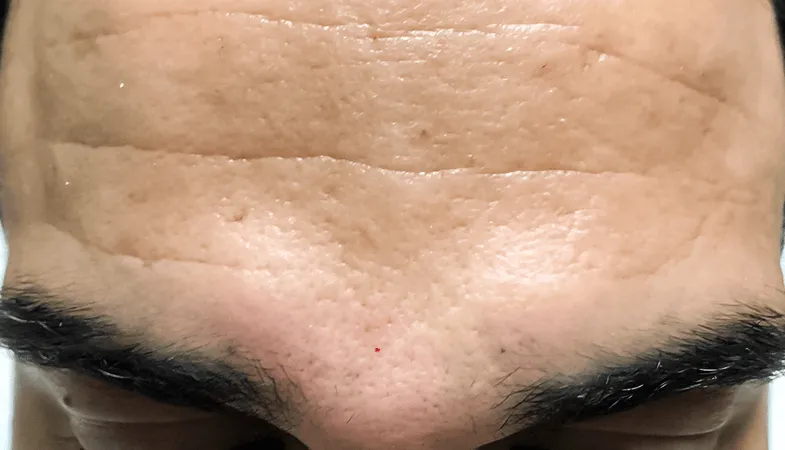 Before and After botox 2