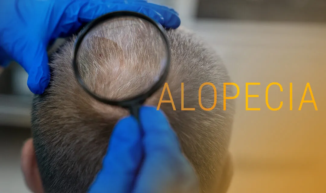 Entendiendo la Alopecia: Tratamientos que Funcionan